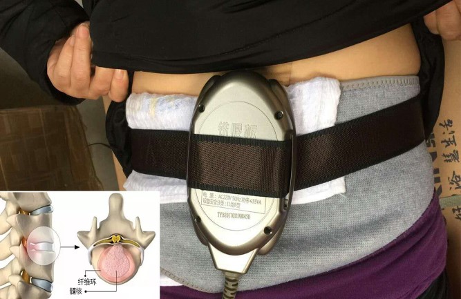铁腰板真的能治疗腰间盘突出吗